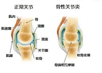 【警惕】我国1亿人以上患有此病，而且人数还在不断增加，你需要极度关注